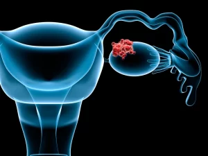 سرطان تخمدان در زنان یک بیماری شایع است