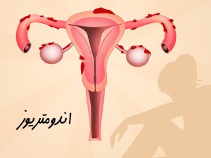 اندومتریوز چیست - نشانه های اندومتریوز