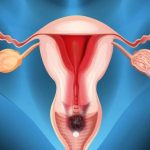 آیا کیست تخمدان باعث ناباروری در زنان می شود؟