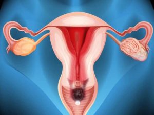 آیا کیست تخمدان باعث ناباروری در زنان می شود؟