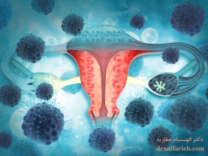 جراحی سرطان تخمدان - درمان سرطان تخمدان