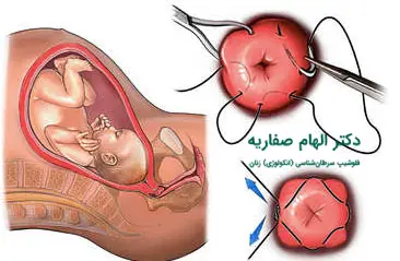 عمل سرکلاژ یا دوختن دهانه رحم برای جلوگیری از سقط جنین