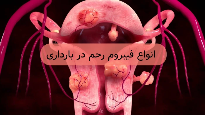 فیبروم رحم در بارداری