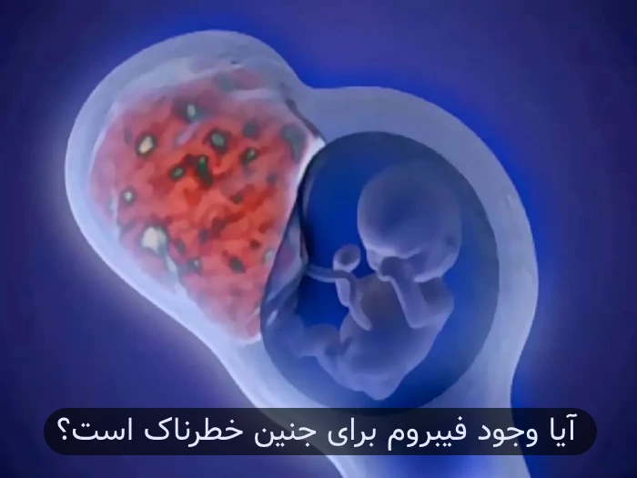 درمان فیبروم رحم در بارداری